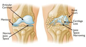 Stem cells for knee pain