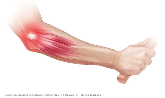 tennis elbow diagram, healing tennis elbow, lateral epicondylitis, non-surgical tennis elbow healing